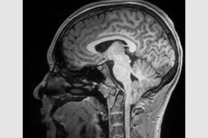 MRI scan shows a Chiari type-1 malformation