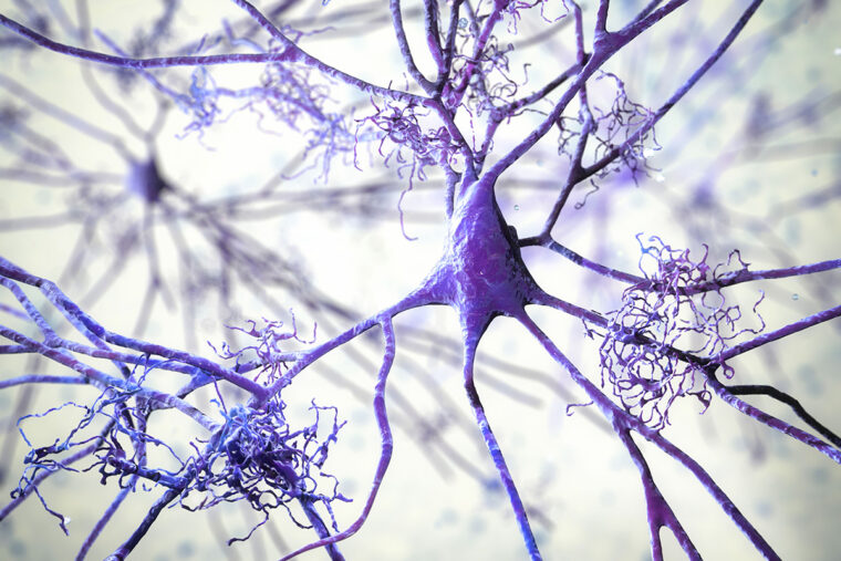 a 3D illustration in purple of neurons undergoing degeneration