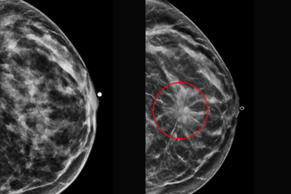 Analyzing multiple mammograms improves breast cancer risk prediction