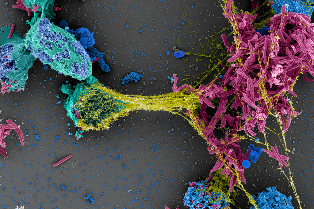 Scanning electron microscopy of infected neutrophils