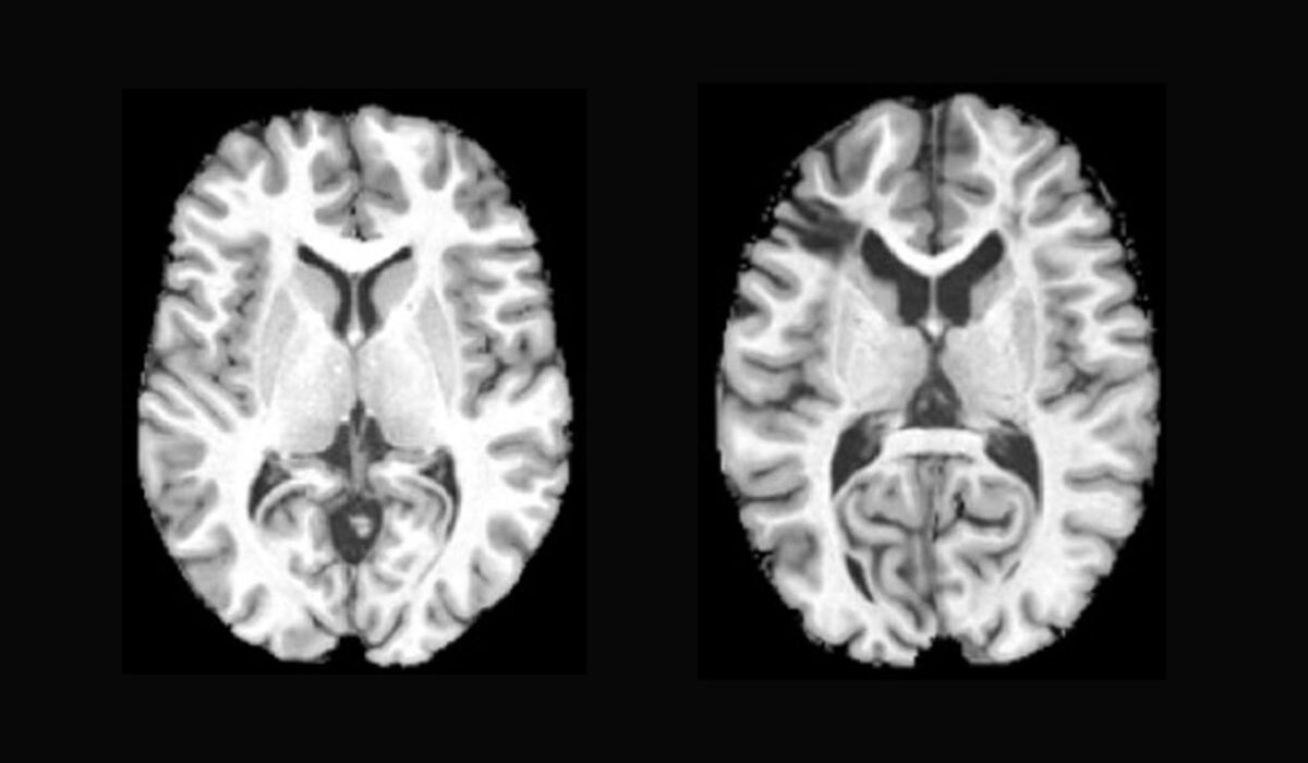 brain images of a healthy individual and a sickle cell patient