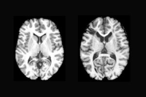 brain images of a healthy individual and a sickle cell patient