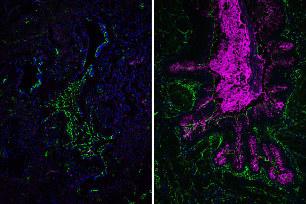 Genetic analysis explains rare disease severity, points to possible treatment