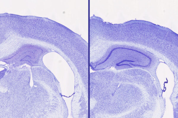 Sleep aid blocks neurodegeneration in mice