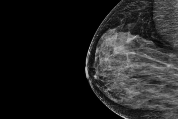 AI-based breast cancer risk technology receives FDA Breakthrough Device designation