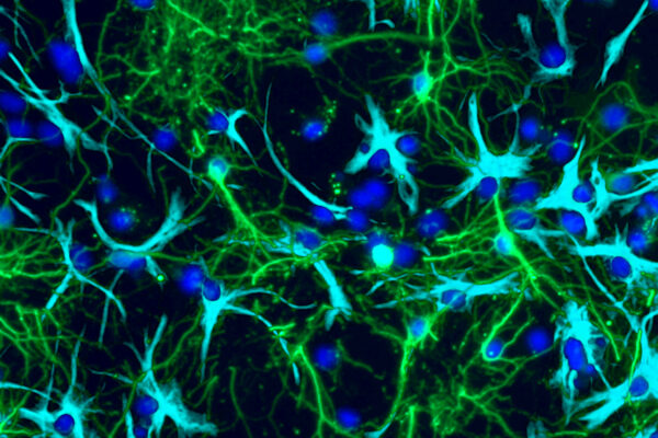 Study sheds light on how pediatric brain tumors grow
