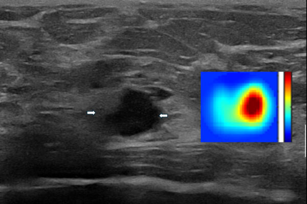 Imaging technique can reduce benign breast biopsies by 25%