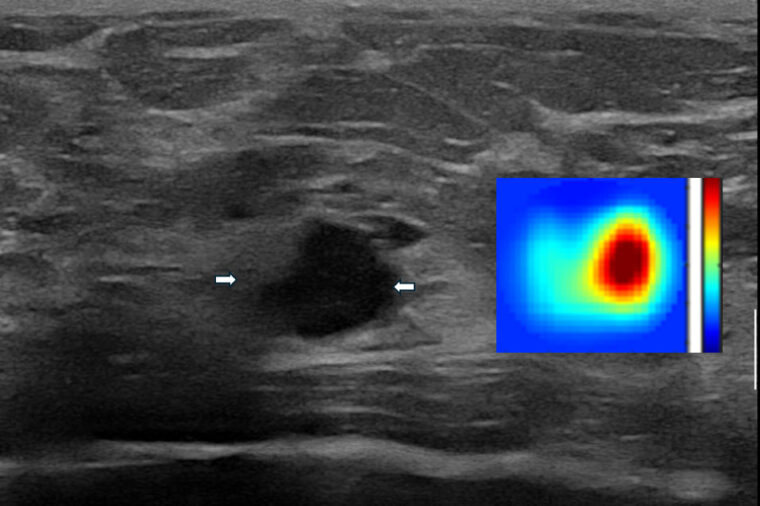 imaging of breast tissue