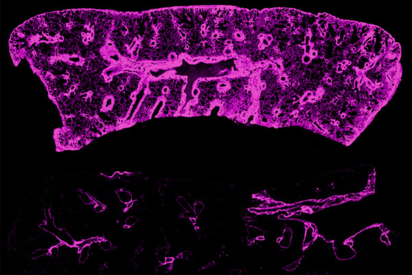 Surprising culprit leads to chronic rejection of transplanted lungs, hearts