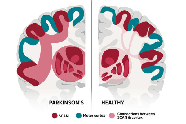 Brain network responsible for Parkinson’s disease identified