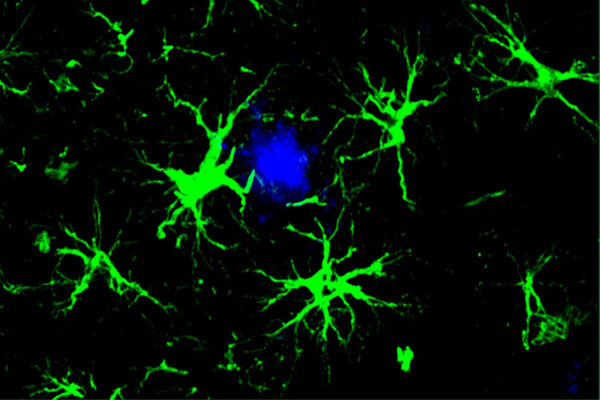 Enhanced brain cells clear away dementia-related proteins