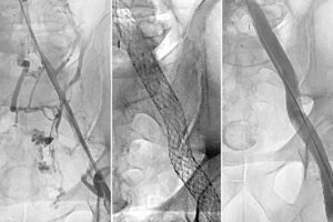 Vendantham_thrombosis