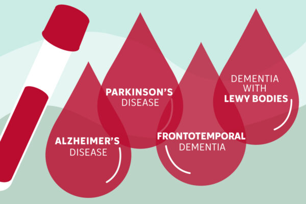 Blood test powered by AI could transform diagnosis of dementia