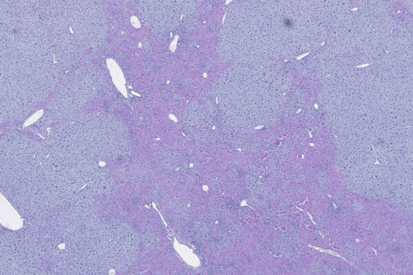 New clues to disease severity identified in alpha1-antitrypsin deficiency