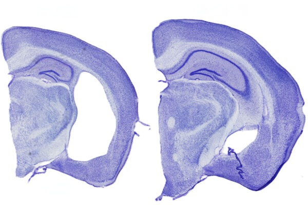Key path to Alzheimer’s-like brain damage starts outside the brain