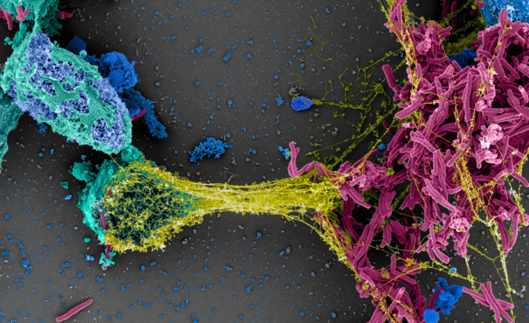 A close-up image of mycobacteria, which can cause serious pulmonary infections. The image shows the bacteria stained in blue, pink and yellow.