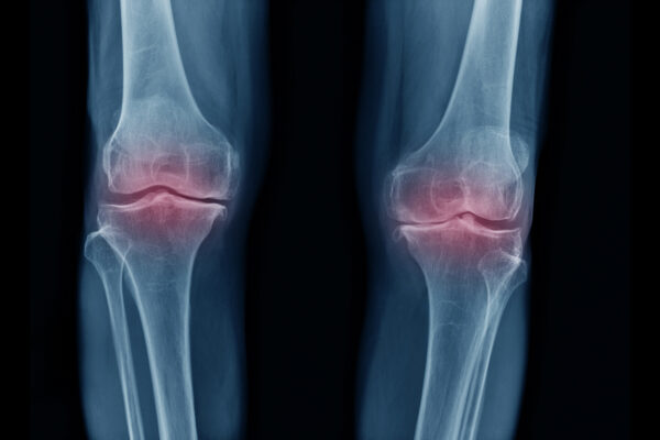 Osteoarthritis therapy study advances with $17 million from ARPA-H