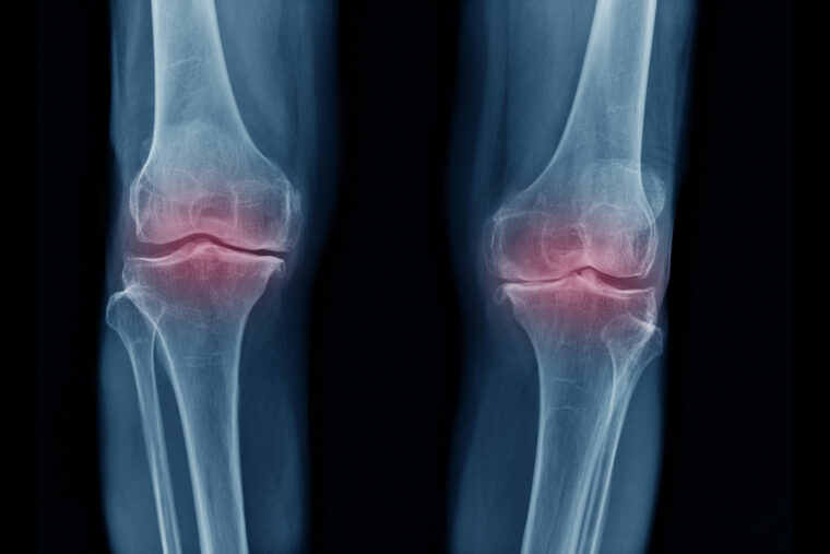 Osteoarthritis therapy study advances with ARPA-H funding